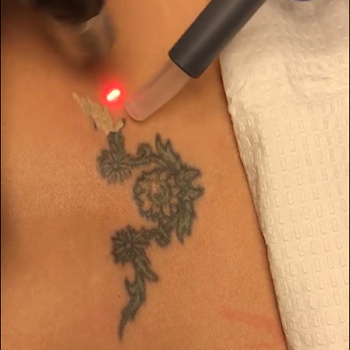 Procedure Video Phoenix Tattoo Removal  Zimmer Cryo Minimize Pain