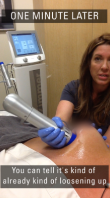 Salzman - Z Wave treatment demo - capsular contracture post breast augmentation