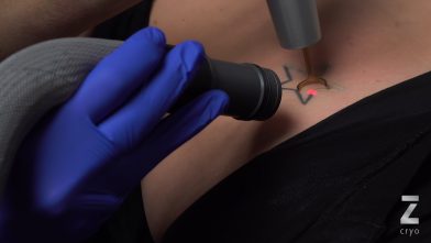 Absolute Laser Tattoo Removal Zimmer Cryo