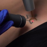 Absolute Laser Tattoo Removal Relies on Zimmer Cryo for Skin Cooling during Laser Treatments
