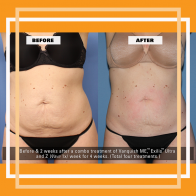 SALZMAN Before After Non Invasive FAT REDUCTION adding Z WAVE FEATURE_SM