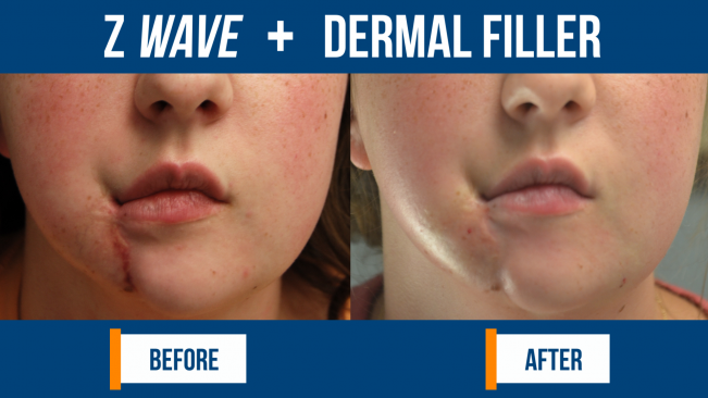 Dr Clemons - Renovus Medical Spa - Z Wave - Z News Before After