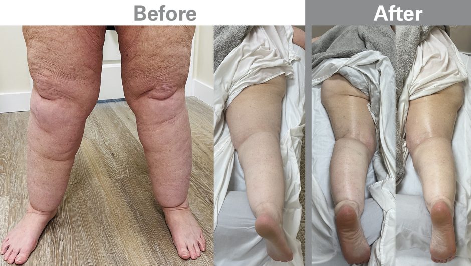 Cara BEFORE & After Compilation - Z Wave Treatment