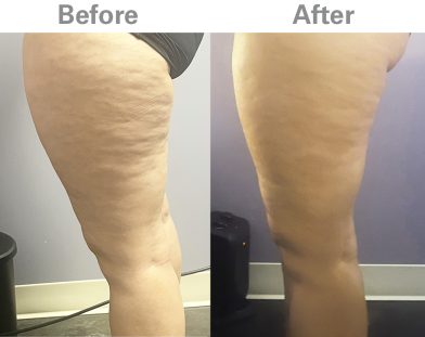 Z Wave Before & After - Sophia - Side - A to Z News