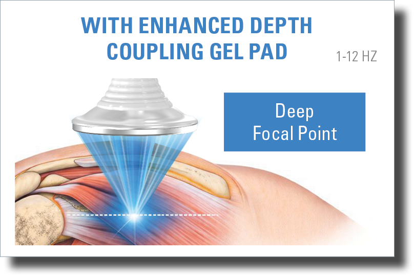 DualWave FX focused shockwave therapy applicator with enhanced depth coupling gel pad showing deep focal point targeting within musculoskeletal tissue.
