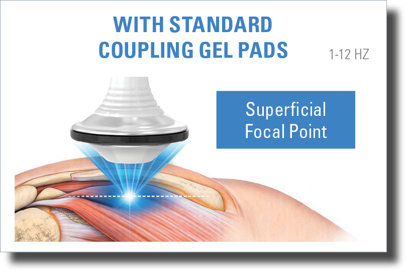 DualWave FX focused shockwave therapy applicator with standard coupling gel pad illustrating superficial focal point targeting in musculoskeletal tissue.