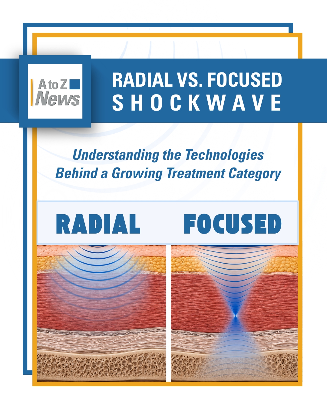 Radial vs Focused Shockwave Therapy: Key Differences, Technologies ...