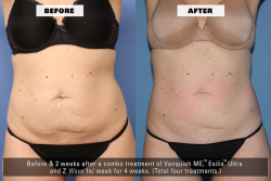 Before After - Front - Z Wave for Enhanced Fat Reduction