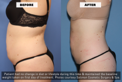 Before After - Side - Z Wave for Enhanced Fat Reduction